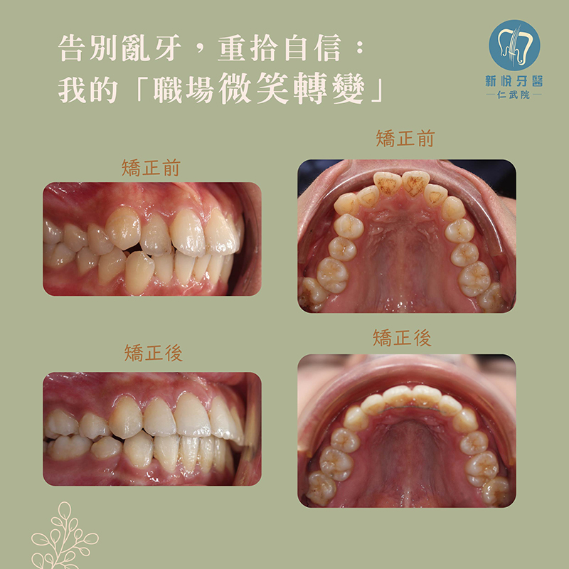 告別亂牙，你也可以！的第2張圖片